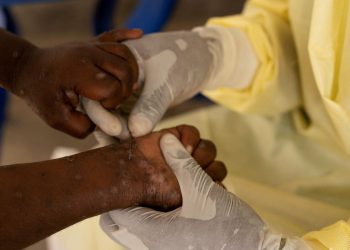 África declara emergência em saúde pública por epidemia de mpox